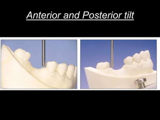 Anterior and Posterior tilt
 