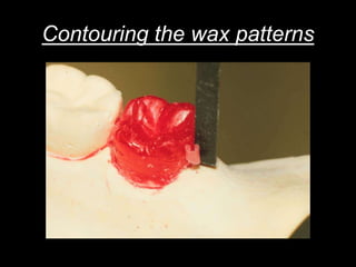 Contouring the wax patterns
 