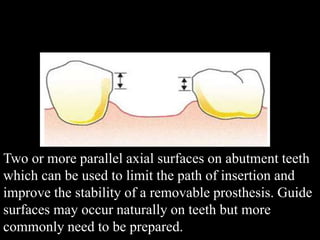 Two or more parallel axial surfaces on abutment teeth
which can be used to limit the path of insertion and
improve the stability of a removable prosthesis. Guide
surfaces may occur naturally on teeth but more
commonly need to be prepared.
 