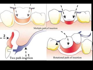 Multiple path of insertion
Two path insertion Rotational path of insertion
 