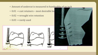 • Amount of undercut is measured in hundredths of an inch
• 0.01 → cast retainers – most desirable location
• 0.02 → wrought wire retention
• 0.03 → rarely used
 