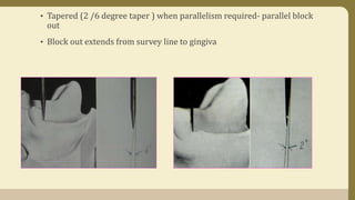• Tapered (2 /6 degree taper ) when parallelism required- parallel block
out
• Block out extends from survey line to gingiva
 