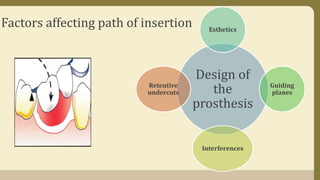 Factors affecting path of insertion
Design of
the
prosthesis
Esthetics
Guiding
planes
Interferences
Retentive
undercuts
 