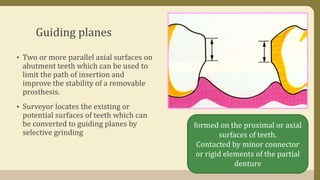 Guiding planes
• Two or more parallel axial surfaces on
abutment teeth which can be used to
limit the path of insertion and
improve the stability of a removable
prosthesis.
• Surveyor locates the existing or
potential surfaces of teeth which can
be converted to guiding planes by
selective grinding
formed on the proximal or axial
surfaces of teeth.
Contacted by minor connector
or rigid elements of the partial
denture
 