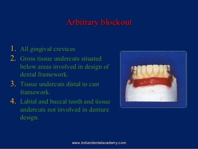 Types Of Undercut In Dentistry - 74