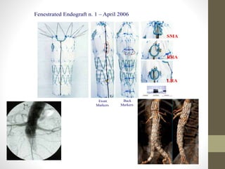 Front
Markers
Back
Markers
Fenestrated Endograft n. 1 – April 2006
SMA
RRA
LRA
aft n. 1 – April 2006
Vascular Surgery – Bologna University
Iuxtarenal AAA and fenestrated endografts
 