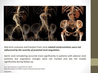 Mid-term outcome and freedom from neck-related reinterventions were not
influenced by the severity of proximal neck angulation.
Aortic neck remodeling occurred more significantly in patients with adverse neck
anatomy but angulation changes were not marked and did not modify
significantly during follow-up
Eur J Vasc Endovasc Surg (2015) 49, 19e27
Mid-Term Results of EVAR in Severe Proximal Aneurysm Neck
Angulation
 