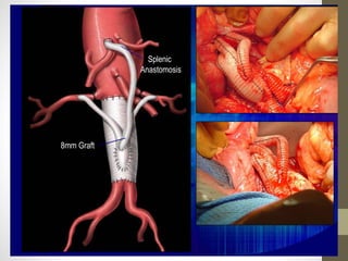 8mm Graft
Splenic
Anastomosis
 