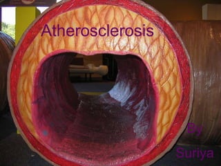 Atherosclerosis By Suriya 