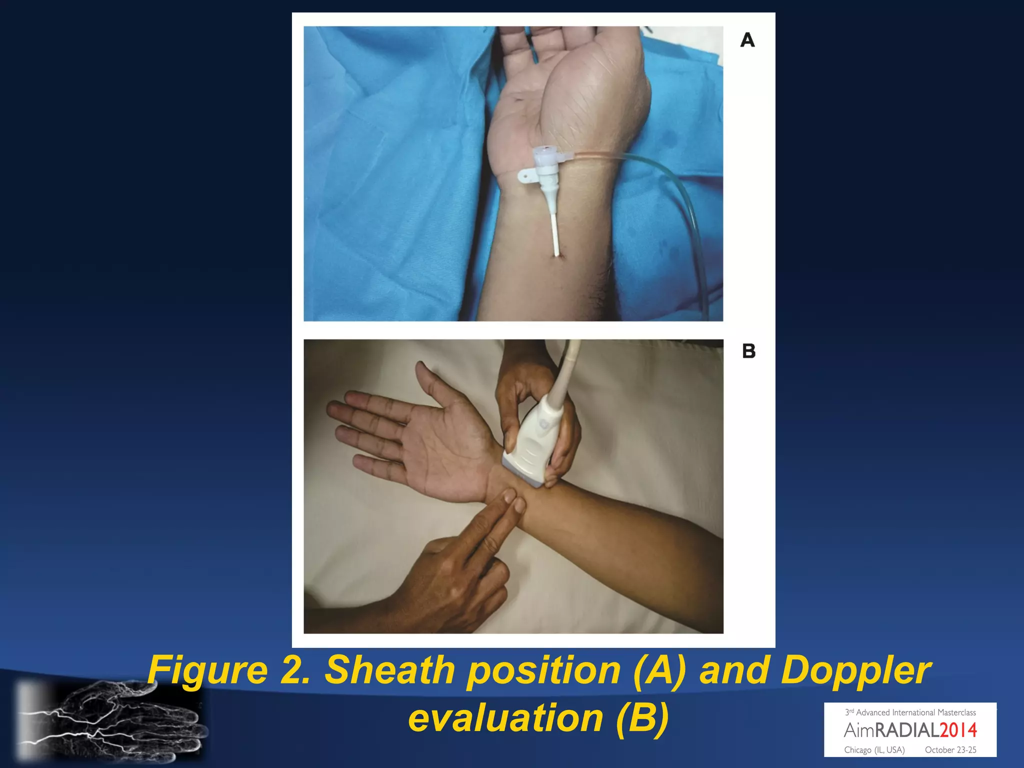 Dharma S - AIMRADIAL 2014 - Nitroglycerin and radial artery occlusion | PPT