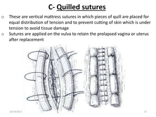 C- Quilled sutures
o These are vertical mattress sutures in which pieces of quill are placed for
equal distribution of tension and to prevent cutting of skin which is under
tension to avoid tissue damage
o Sutures are applied on the vulva to retain the prolapsed vagina or uterus
after replacement
10/14/2017 13
 