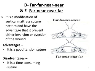 D- Far-far-near-near
& E- Far-near-near-far
Advantages –
• It is a good tension suture
Disadvantages –
• It is a time consuming
suture
o It is a modification of
vertical mattress suture
pattern and have the
advantage that it prevent
either inversion or eversion
of the wound
10/14/2017 14
 