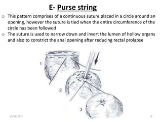 E- Purse string
o This pattern comprises of a continuous suture placed in a circle around an
opening, however the suture is tied when the entire circumference of the
circle has been followed
o The suture is used to narrow down and invert the lumen of hollow organs
and also to constrict the anal opening after reducing rectal prolapse
10/14/2017 19
 