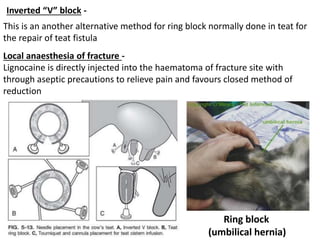 Ring block
(umbilical hernia)
Inverted “V” block -
This is an another alternative method for ring block normally done in teat for
the repair of teat fistula
Local anaesthesia of fracture -
Lignocaine is directly injected into the haematoma of fracture site with
through aseptic precautions to relieve pain and favours closed method of
reduction
 