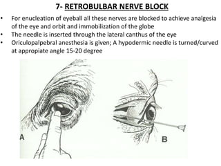 7- RETROBULBAR NERVE BLOCK
• For enucleation of eyeball all these nerves are blocked to achieve analgesia
of the eye and orbit and immobilization of the globe
• The needle is inserted through the lateral canthus of the eye
• Oriculopalpebral anesthesia is given; A hypodermic needle is turned/curved
at appropiate angle 15-20 degree
 