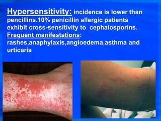 Hypersensitivity: incidence is lower than
pencillins.10% penicillin allergic patients
exhibit cross-sensitivity to cephalosporins.
Frequent manifestations:
rashes,anaphylaxis,angioedema,asthma and
urticaria
 