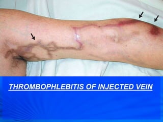 THROMBOPHLEBITIS OF INJECTED VEIN
 