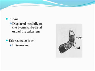 Cuboid
   Displaced medially on
    the dysmorphic distal
    end of the calcaneus

Talonavicular joint
   In inversion
 