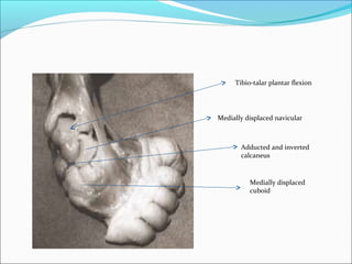 Tibio-talar plantar flexion




Medially displaced navicular



       Adducted and inverted
       calcaneus


          Medially displaced
          cuboid
 
