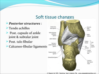 Soft tissue changes
 Posterior structures :
 Tendo achilles
 Post. capsule of ankle
  joint & subtalar joint
 Post. talo fibular
 Calcaneo-fibular ligaments
 