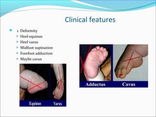 Clinical features
   1. Deformity
     Heel equinus
     Heel varus
     Midfoot supination
     Forefoot adduction
     Maybe cavus
 
