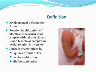 Definition
Developmental deformation
 of foot
 Rotational subluxation of
 talocalcaneonavicular joint
 complex with talus in plantar
 flexion & subtalar complex in
 medial rotation & inversion
Clinically characterized by
   Equinus & varus of heel
   Forefoot adduction
   Midfoot supination
 