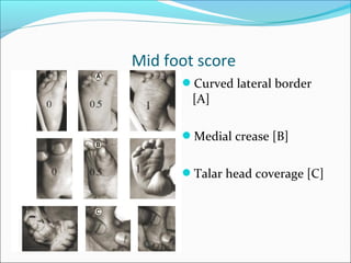 Mid foot score
      Curved lateral border
        [A]

      Medial crease [B]


      Talar head coverage [C]
 