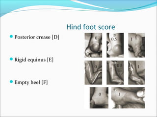 Hind foot score
Posterior crease [D]



Rigid equinus [E]



Empty heel [F]
 
