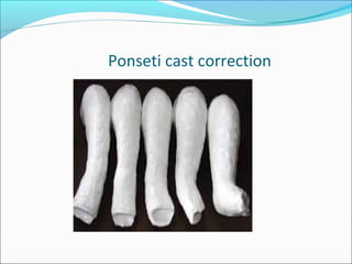 Ponseti cast correction
 