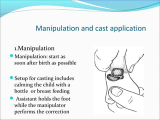 Manipulation and cast application

  1.Manipulation
Manipulation: start as
  soon after birth as possible

Setup for casting includes
 calming the child with a
 bottle or breast feeding
 Assistant holds the foot
 while the manipulator
 performs the correction
 