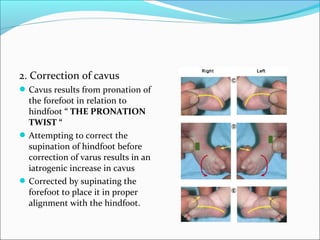 2. Correction of cavus
 Cavus results from pronation of
  the forefoot in relation to
  hindfoot “ THE PRONATION
  TWIST “
 Attempting to correct the
  supination of hindfoot before
  correction of varus results in an
  iatrogenic increase in cavus
 Corrected by supinating the
  forefoot to place it in proper
  alignment with the hindfoot.
 