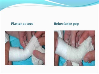 Plaster at toes   Below knee pop
 