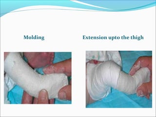 Molding   Extension upto the thigh
 
