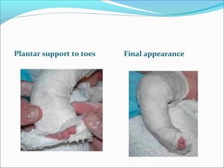 Plantar support to toes   Final appearance
 