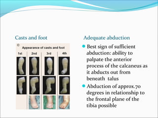 Casts and foot   Adequate abduction
                 Best sign of sufficient
                  abduction: ability to
                  palpate the anterior
                  process of the calcaneus as
                  it abducts out from
                  beneath talus
                 Abduction of approx.70
                  degrees in relationship to
                  the frontal plane of the
                  tibia possible
 