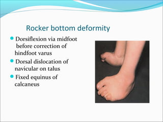 Rocker bottom deformity
Dorsiflexion via midfoot
  before correction of
 hindfoot varus
Dorsal dislocation of
 navicular on talus
Fixed equinus of
 calcaneus
 