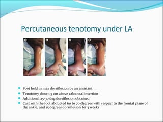 Percutaneous tenotomy under LA




   Foot held in max dorsiflexion by an assistant
   Tenotomy done 1.5 cm above calcaneal insertion
   Additional 25-30 deg dorsiflexion obtained
   Cast with the foot abducted 60 to 70 degrees with respect to the frontal plane of
    the ankle, and 15 degrees dorsiflexion for 3 weeks
 