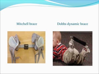 Mitchell brace   Dobbs dynamic brace
 