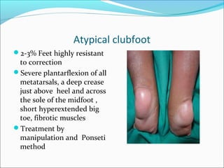 Atypical clubfoot
2-3% Feet highly resistant
 to correction
Severe plantarflexion of all
 metatarsals, a deep crease
 just above heel and across
 the sole of the midfoot ,
 short hyperextended big
 toe, fibrotic muscles
Treatment by
 manipulation and Ponseti
 method
 