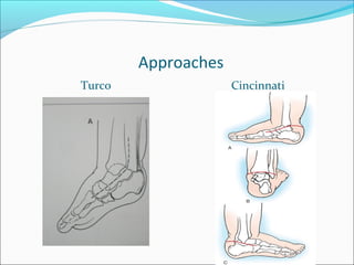 Approaches
Turco                Cincinnati
 