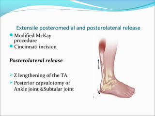 Extensile posteromedial and posterolateral release
Modified McKay
 procedure
Cincinnati incision

Posterolateral release

 Z lengthening of the TA
 Posterior capsulotomy of
 Ankle joint &Subtalar joint
 