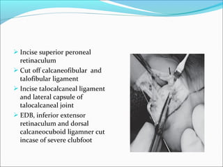  Incise superior peroneal
  retinaculum
 Cut off calcaneofibular and
  talofibular ligament
 Incise talocalcaneal ligament
  and lateral capsule of
  talocalcaneal joint
 EDB, inferior extensor
  retinaculum and dorsal
  calcaneocuboid ligamner cut
  incase of severe clubfoot
 