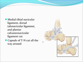 Medial tibial navicular
 ligament, dorsal
 talonavicular ligamnet,
 and plantar
 calcaneonavicular
 ligament cut
Capsule of T-N cut all the
 way around
 
