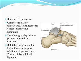  Bifurcated ligament cut
 Complete release of
  talocalcaneal joint ligaments
  except interosseous
  ligaments
 Detach origin of quadratus
  plantae muscle from
  calcaneus
 Roll talus back into ankle
  koint, if not incise post.
  talofibular ligament, post.
  Portion of deep deltoid
  ligament
 