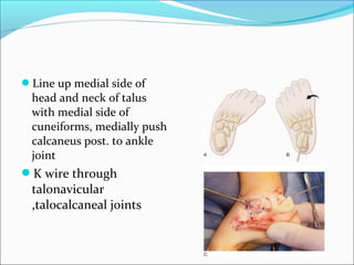 Line up medial side of
 head and neck of talus
 with medial side of
 cuneiforms, medially push
 calcaneus post. to ankle
 joint
K wire through
 talonavicular
 ,talocalcaneal joints
 
