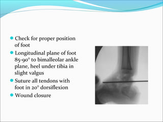 Check for proper position
 of foot
Longitudinal plane of foot
 85-90° to bimalleolar ankle
 plane, heel under tibia in
 slight valgus
Suture all tendons with
 foot in 20° dorsiflexion
Wound closure
 