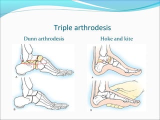 Triple arthrodesis
Dunn arthrodesis         Hoke and kite
 