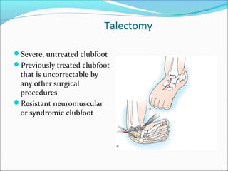Talectomy

Severe, untreated clubfoot
Previously treated clubfoot
 that is uncorrectable by
 any other surgical
 procedures
Resistant neuromuscular
 or syndromic clubfoot
 