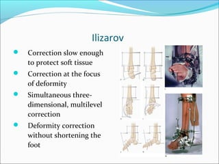 Ilizarov
   Correction slow enough
    to protect soft tissue
   Correction at the focus
    of deformity
   Simultaneous three-
    dimensional, multilevel
    correction
   Deformity correction
    without shortening the
    foot
 