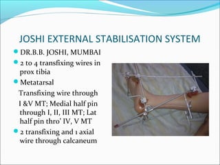 JOSHI EXTERNAL STABILISATION SYSTEM
DR.B.B. JOSHI, MUMBAI
2 to 4 transfixing wires in
 prox tibia
Metatarsal
 Transfixing wire through
 I &V MT; Medial half pin
 through I, II, III MT; Lat
 half pin thro’ IV, V MT
2 transfixing and 1 axial
 wire through calcaneum
 